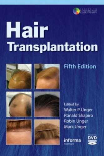 Hair Transplantation, Fifth Edition (Series in Cosmetic and Laser Therapy)