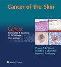 Cancer of the Skin