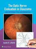 The Optic Nerve Evaluation in Glaucoma